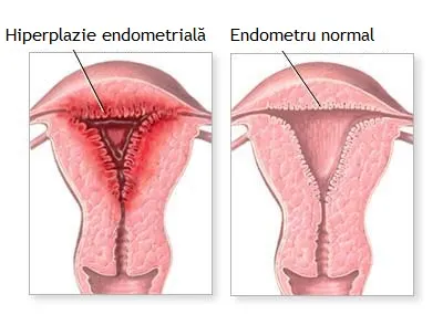 Hiperplazia endometrială