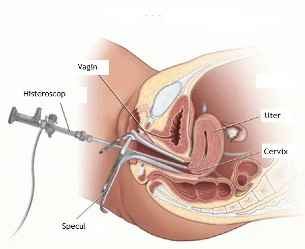 Histeroscopia
