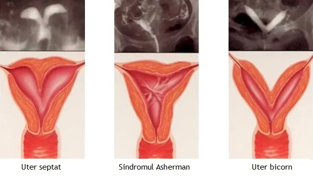 Sinechia uterină